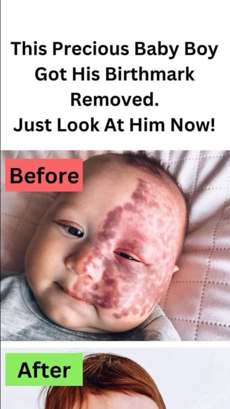 The True Motivation Behind a Mother’s Decision: Removing her Son’s Birthmark with a Laser Sparks Criticism