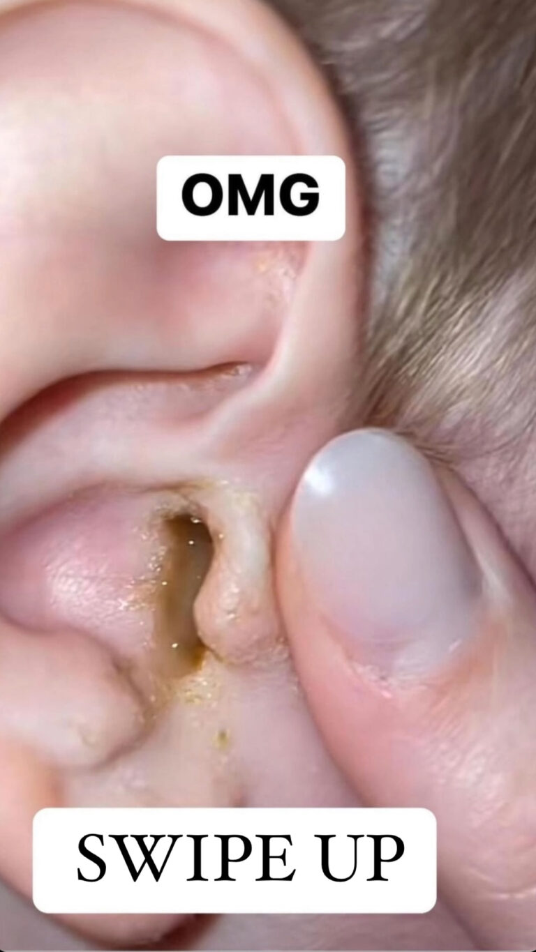 Ear Infection: 6 Signs You Have It