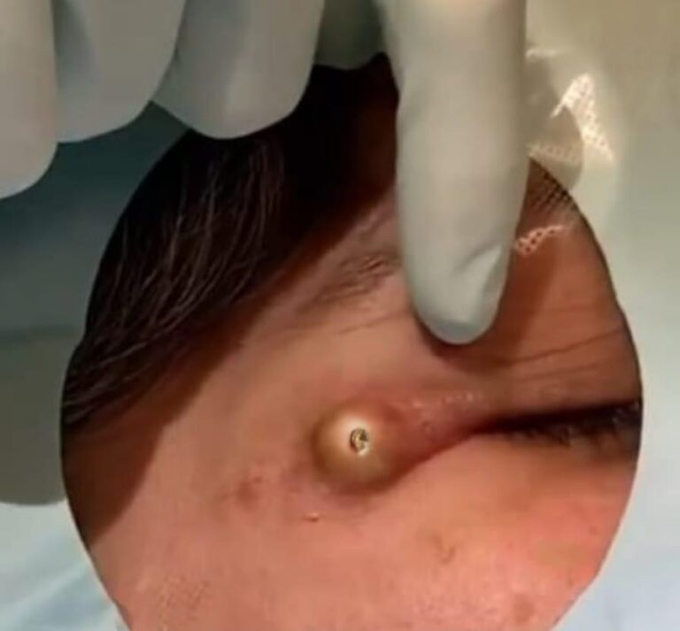 Dr. Pimple Popper Popping 31