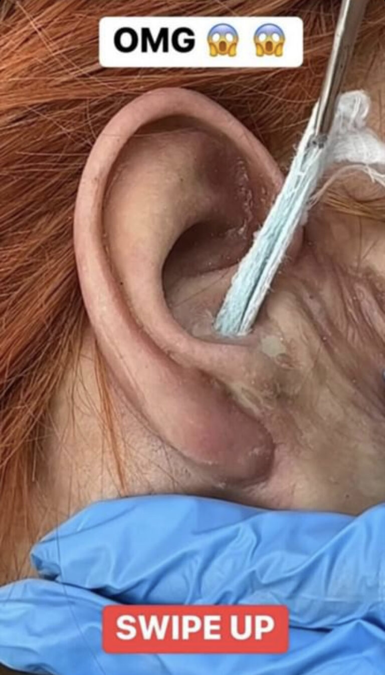 St. Weird substance removed from ear