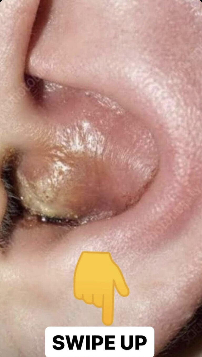 Ear Infection: 6 Signs You Have It