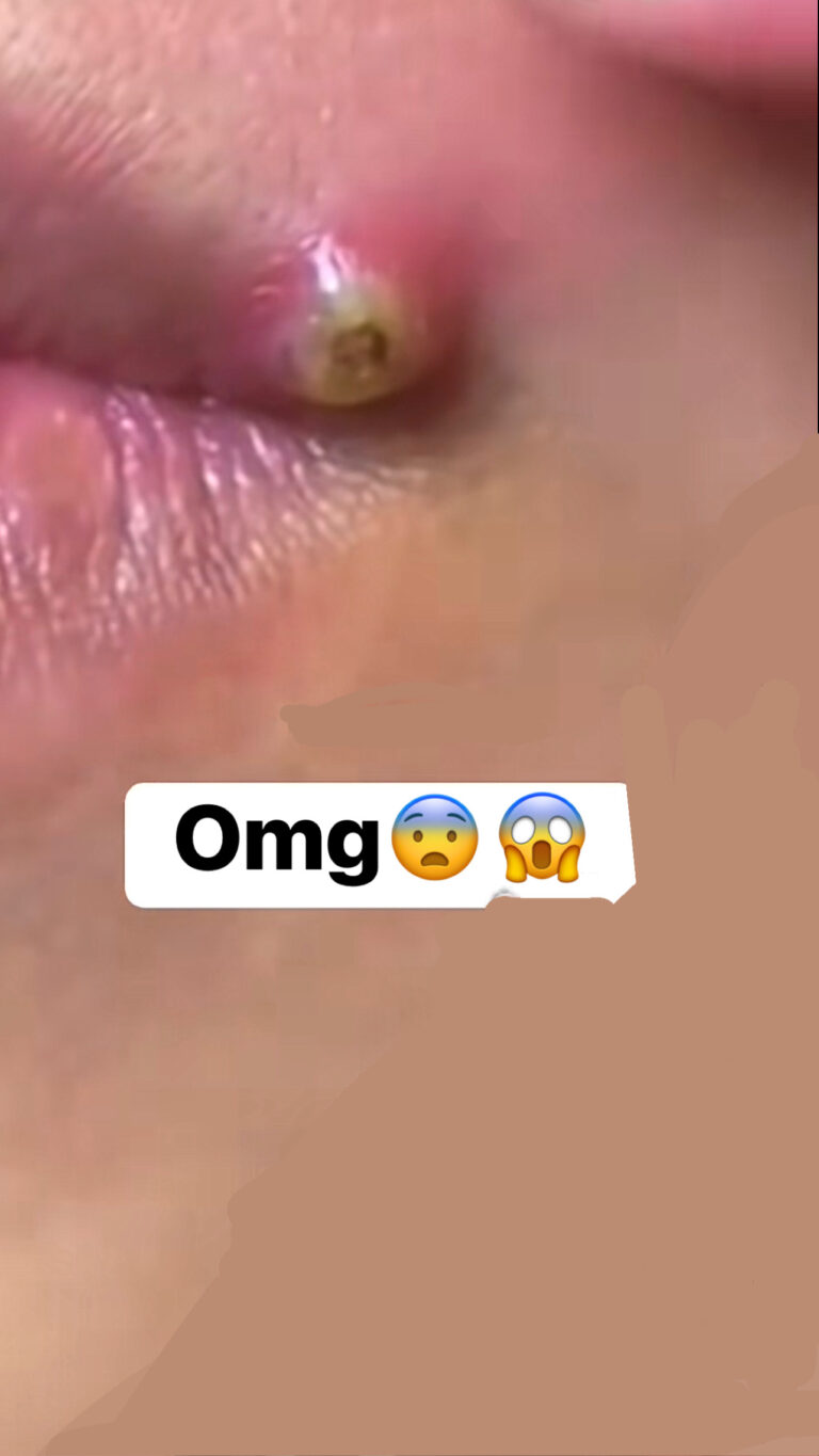 Amazing pimple removal