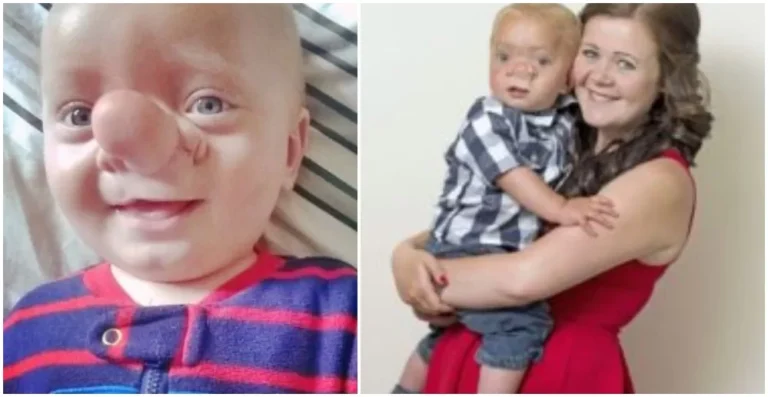 THIS baby’s nickname was Pinocchio and check out what he looks like years later…