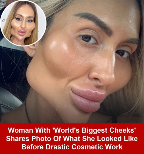 Woman With Huge Cheeks Shares Her Before Pictures