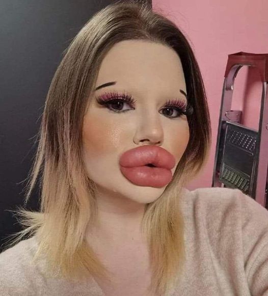 24-year-old Bulgarian woman wants to have the biggest lips in the world