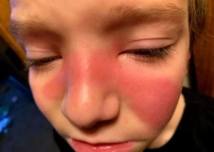 Her son came home with a red mark on his face, so she rushed him to the Emergency Room. This is scary stuff for parents everywhere.