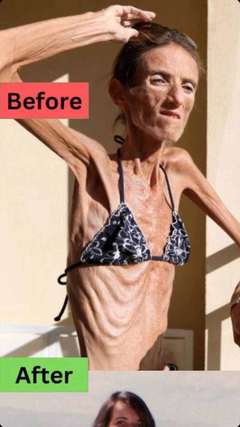 THE WORLD’S THINNEST WOMAN’S BATTLE AGAINST ANOREXIA WILL LEAVE YOU SPEECHLESS!