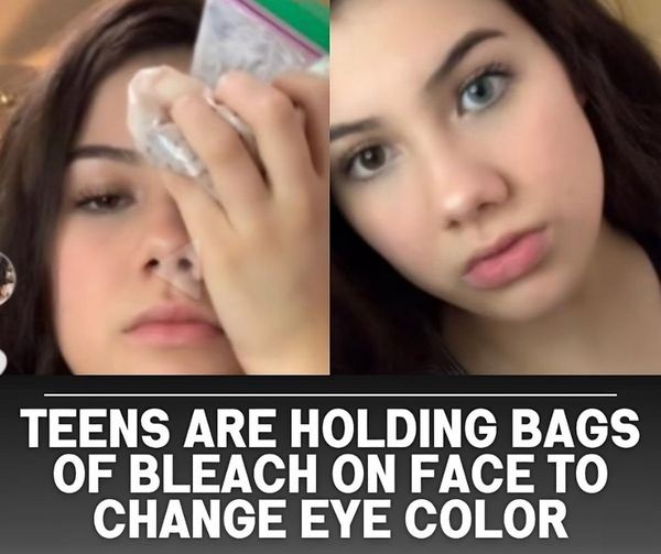 Teens Are Holding Bags Of Bleach On Face To Change Eye Color