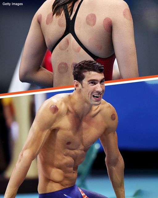 Why Were Olympic Athletes & Other Celebs Spotted with Dark Red Circles on Their Bodies?