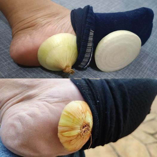 What are the effects of placing an onion in your socks while you sleep?